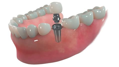 Dental Implants | Dallas Dental Group | Dallas, TX