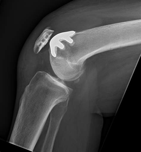 Patellofemoral arthroplasty | Image | Radiopaedia.org