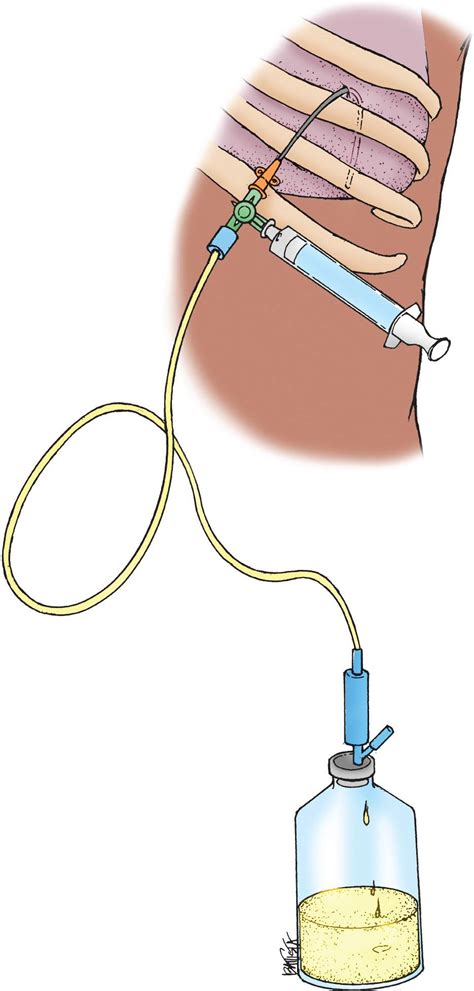 Thoracentesis Procedure