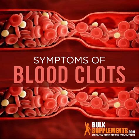 Blood Clots Symptoms, Causes and Treatment