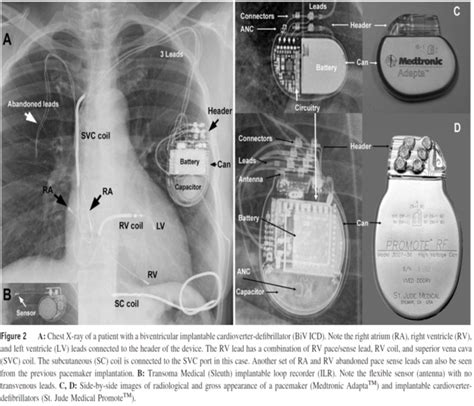 Medtronic Pacemaker X Ray Identification