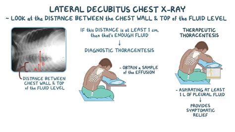 Thoracentesis: Purpose, Procedure, Risks Recovery, 47% OFF