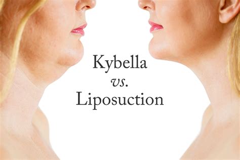 Why Use Kybella vs. Liposuction?