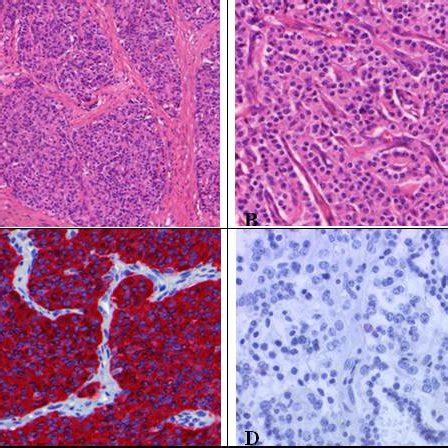 (PDF) Neuroendocrine Tumors of the Lung