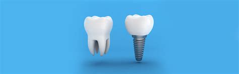 Dental Implants: Procedure, Risks, and Benefits