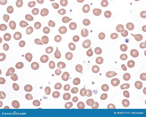 Teardrop Cells (dacrocytes) in Peripheral Blood. Stock Photo - Image of laboratory, cell: 283647174