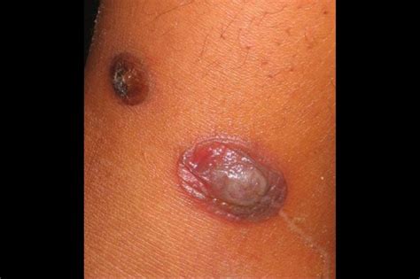 Derm Dx: Asymptomatic Blisters on a Child's Upper Leg - Dermatology Advisor