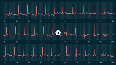 Junctional Rhythm Vs. Sinus Rhythm on Your Watch ECG | Qaly