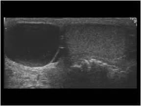 Urinary Tract and male reproductive system | 2.3 Scrotum : Case 2.3.2 Hydroceles, cysts and ...