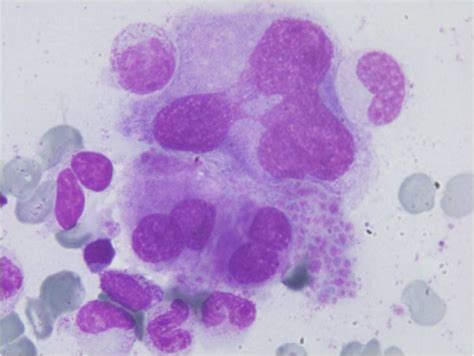 AML post-MDS, monosomy 7