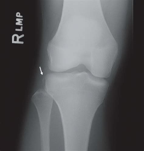 Radiographic Signs of ACL Tear | Radiology Key