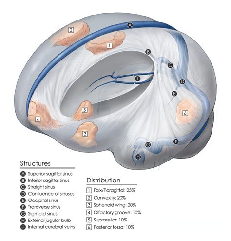 Olfactory Groove Meningioma | The Neurosurgical Atlas, by Aaron Cohen-Gadol, M.D.