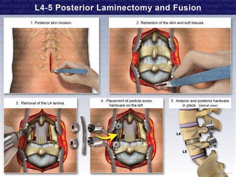 L4-5 Posterior Laminectomy and Fusion - Trial Exhibits Inc.