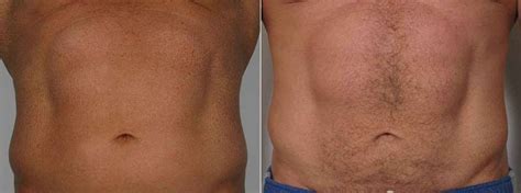 Velashape Before And After.