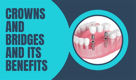 Types of Crowns and Bridges and its Benefits