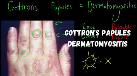 Gottron's Papules - Dermatomyositis - YouTube