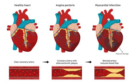 Heart Disease, Hypertension, High Blood Cholesterol - Heart Disease