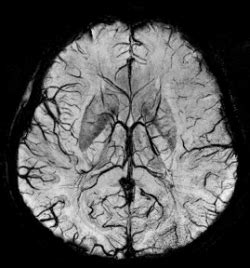 Faster Diagnosis? Hemiplegic Migraine - Headache and Migraine News