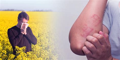 Eczema and Allergies: Understanding the Connection - TodayCaught