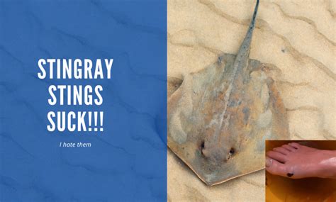 Stingray Stings Suck – Here’s How to Treat Them – The Surfing Handbook