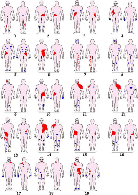 Segmental vitiligo associated with generalized vitiligo (mixed vitiligo ...