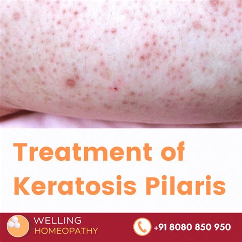 Homeopathy Treatment Of Keratosis Pilaris