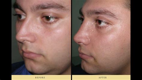 Rhinoplasty & Deviated Nasal Septum surgery for right breath