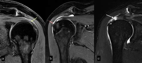 Cureus | Role of Magnetic Resonance Imaging in the Evaluation of Rotator Cuff Tears