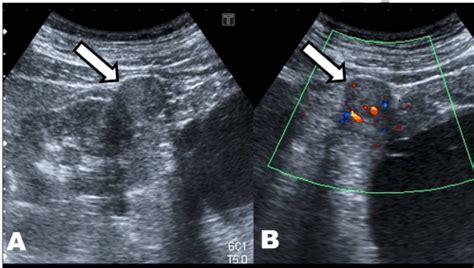 Ultrasound image of the upper pole of right kidney. (A) B-mode image...