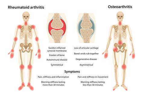 Arthritis Related Pain - Cornell Pain Clinic