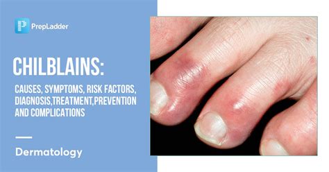 Chilblains: Causes, Symptoms, Risk Factors, Diagnosis, Treatment, Prevention and Complications