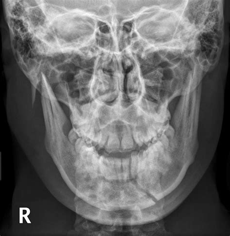 Mandible Fracture X Ray