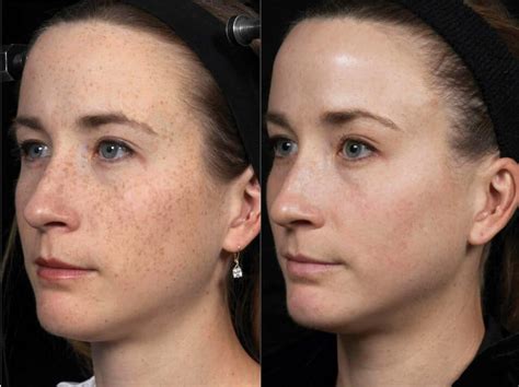 Laser Facial before and after | Emerge Fractional Laser Results