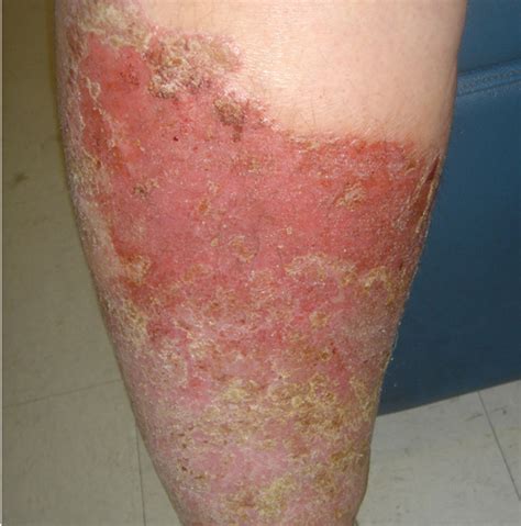 Two erythematous leg rashes- Clinical Advisor