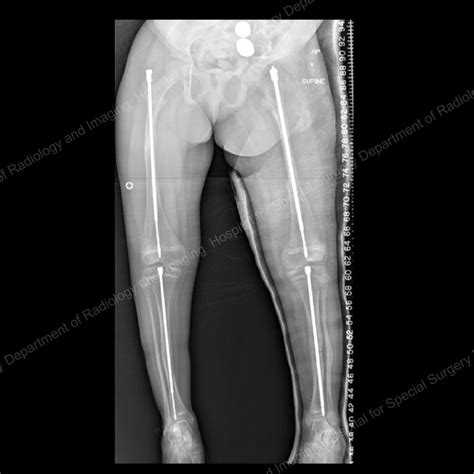 Osteogenesis Imperfecta: Approaches for Treating Children