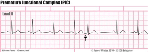 31. Active heterotopic abnormalities (premature beats) – greek.doctor