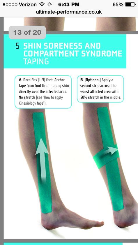 17 Broken tibial plateau ideas | tibial plateau fracture, plateau, fracture