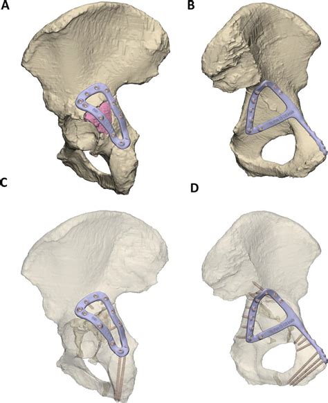 Case 1 left hemipelvis and fracture plate design. A Lateral view of the... | Download Scientific ...