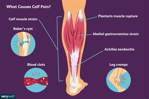 7 Common Causes of Calf Pain and How to Treat Them