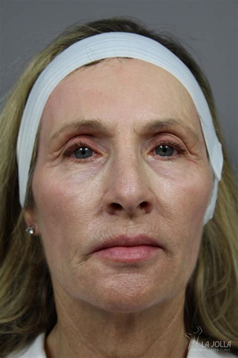 Liquid Facelift Before & After Gallery: Patient 3