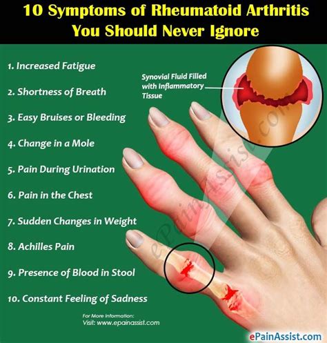 10 Symptoms of Rheumatoid Arthritis You Should Never Ignore | Rheumatoid arthritis symptoms ...