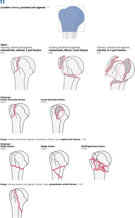 Mechanisms Of Humeral Head Fracture