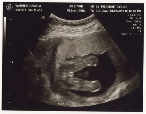 Sweet Baby Makes Three!: 18 weeks 5 days Ultrasound!!