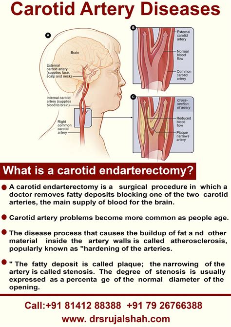 Carotid endarterectomy is a surgical procedure used to reduce the risk of stroke by correcting ...