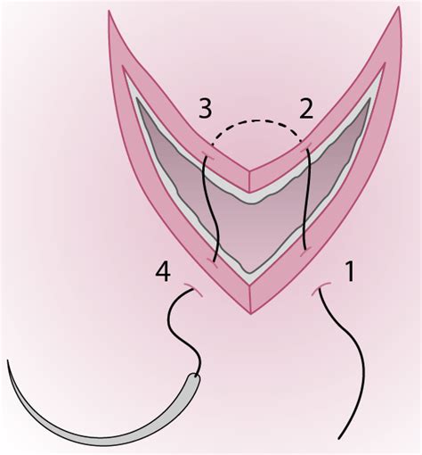 Figure: Flap laceration repair - MSD Manual Professional Edition