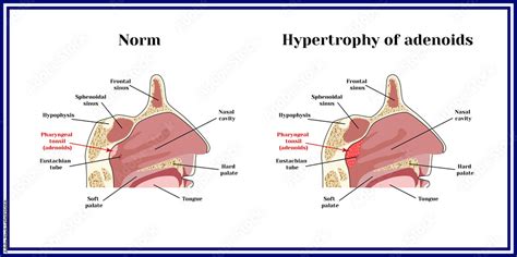 Location of adenoids.The structure of the nasopharynx. Norm and hypertrophy of adenoids. Stock ...