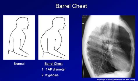 Barrel Chest X Ray