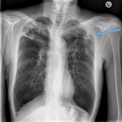 Radiology - Bronchiectasis