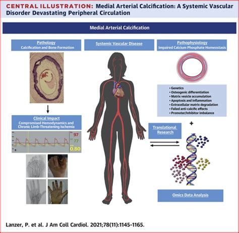 Medial Arterial Calcification: JACC State-of-the-Art Review | Journal ...