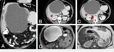 The preoperative contrast enhanced the by the computed tomography and... | Download Scientific ...